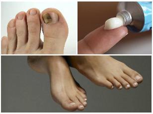 fungus in the nails of the feet ointment