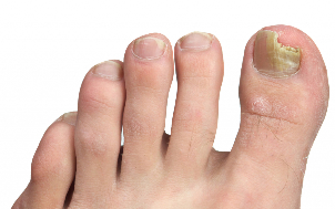 fungus in the nails of the feet of the phase of