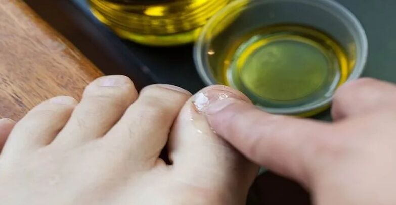Essential oils to combat the fungus