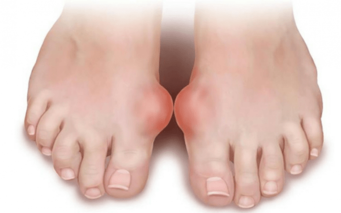 foot deformity as a cause of fungus on the legs