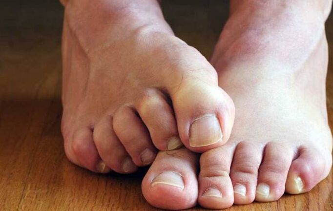 symptoms of scaly fungus on the feet