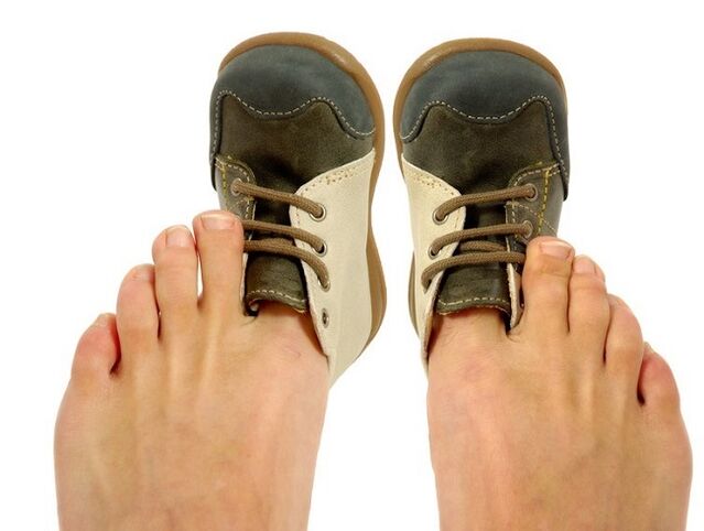 tight shoes as a cause of fungus between the toes