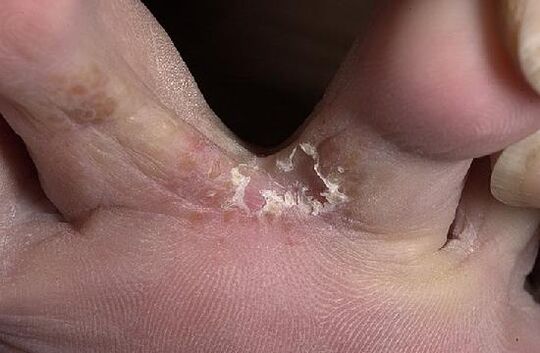 fungal toes