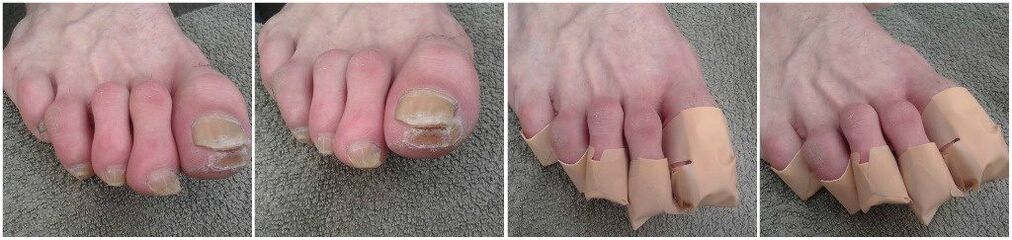Applying patches for toenail fungus