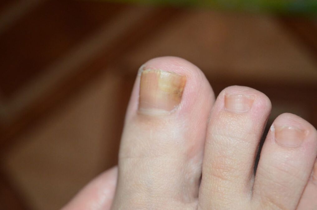 The initial stage of toenail fungus. 