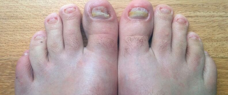 toenail fungus how to treat