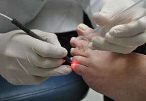 Laser treatment for toenail fungus. 