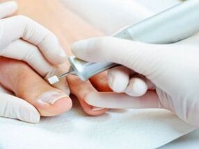 Therapeutic pedicure for toenail fungus. 