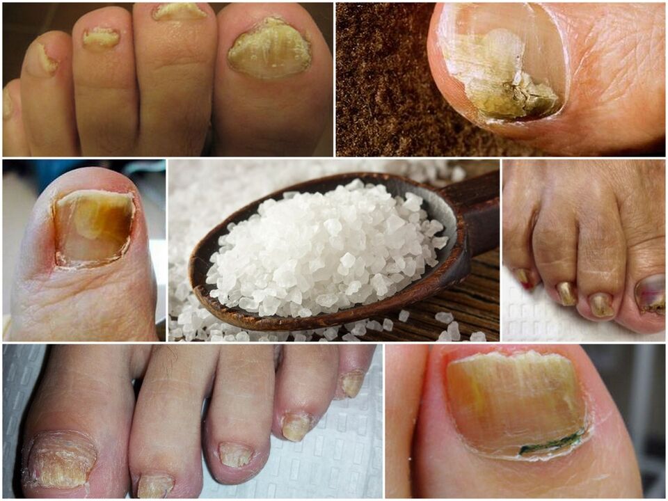The fight against fungus