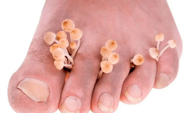 Skin fungus