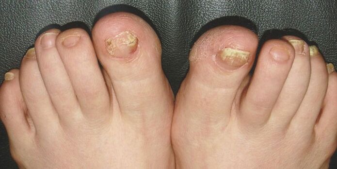 LEGS ONICOMICOSIS