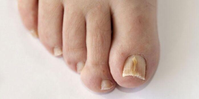 Nail fungus