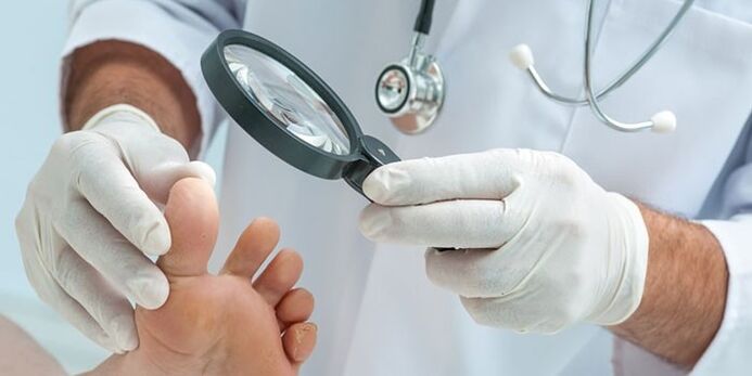 The doctor examined the infected foot with a fungus