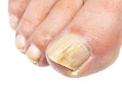 How do you see the nail fungus