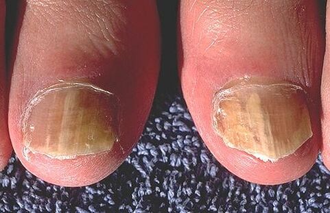Nails affected by dermatophytes