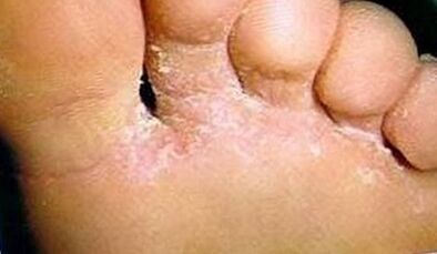 How to recognize the fungus on the fingers