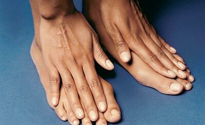How to treat a fungus on the fingers