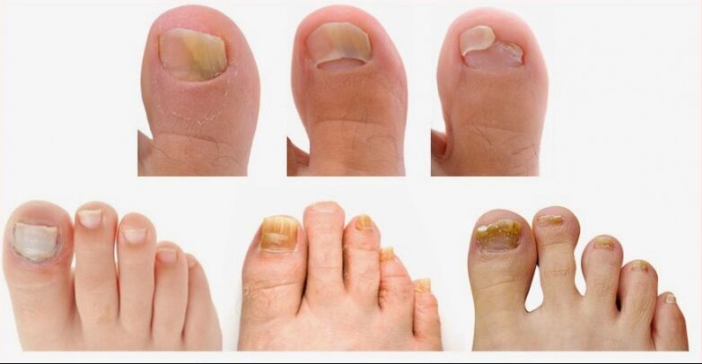 The first signs of onychomycosis
