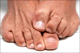Itchy skin on the feet due to a fungal nail infection.