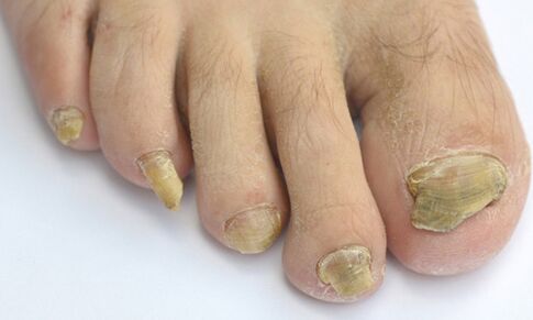 Causes and symptoms of toenail fungus.