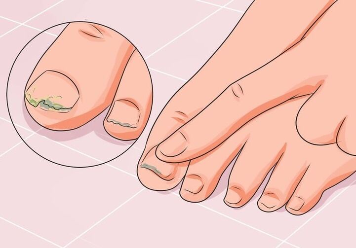 How to treat toenail fungus with drops.