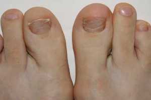 The symptoms of the onset of foot fungus