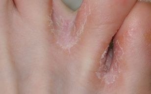 the fungus of the skin on the legs