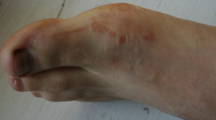 the fungus on the feet of the initial stage of the
