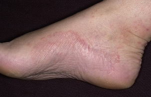 The fungus in the foot