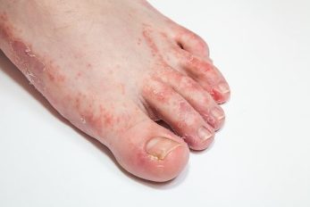 the fungus of feet and nails